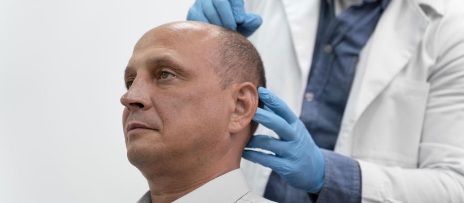 Hombre en el médico por su alopecia