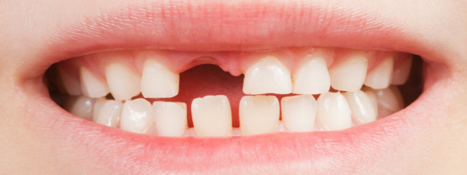 Una buena higiene dental influye sobre la nutrición y la posibilidad de evitar futuras ortodoncias