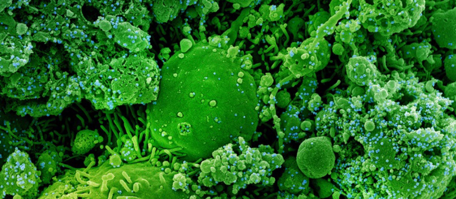 Micrografía electrónica de barrido coloreada de células infectadas crónicamente y parcialmente lisadas (verde) infectadas con una cepa variante de partículas del virus SARS-CoV-2 (azul), aisladas de una muestra de un paciente