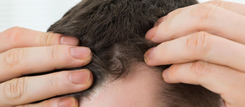 La alopecia areata es una enfermedad autoinmune que provoca la caída del pelo