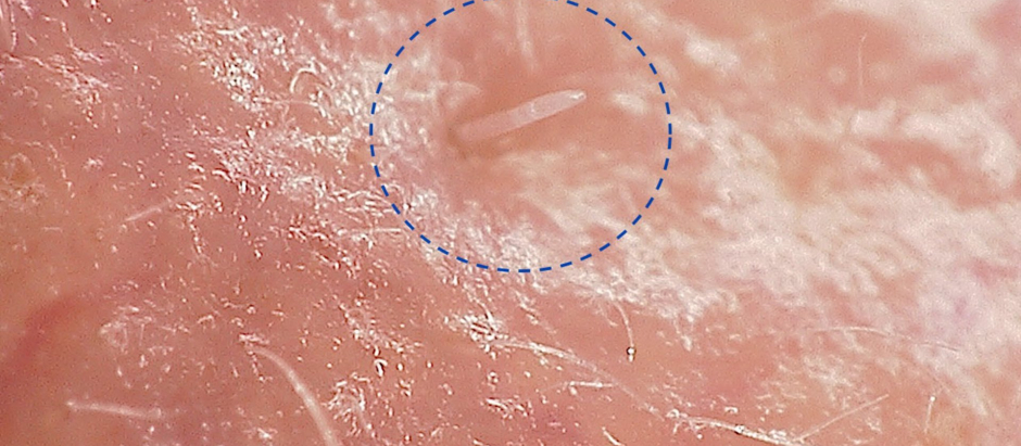 Piel con el ácaro Demodex folliculorum