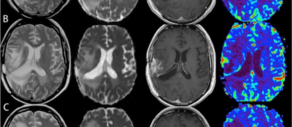 Tumor cerebral observado por medio de una resonancia magnética