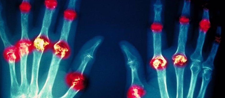 Daño articular de la artritis reumatoide
