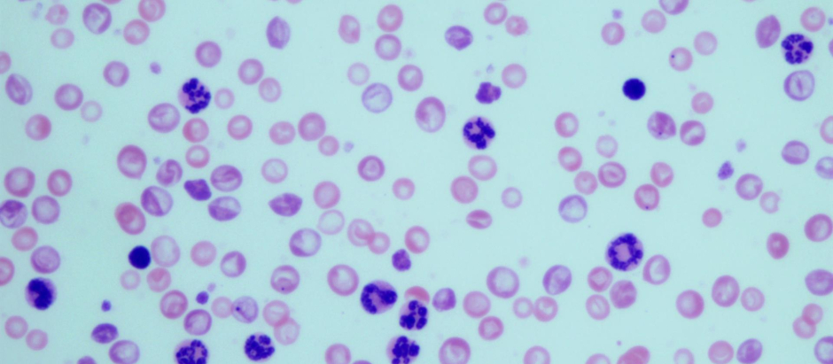 Granulocitos en muestras sanguíneas de ratones con leucemia mielogénica crónica