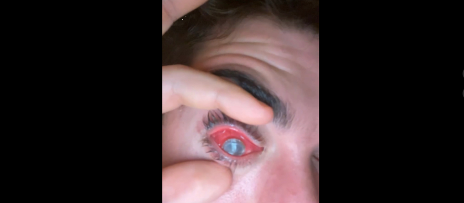 El ojo del tiktoker mikekrumholz13 después de dormir con las lentillas puestas