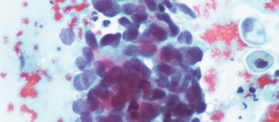 Carcinoma de células escamosas de cuello uterino