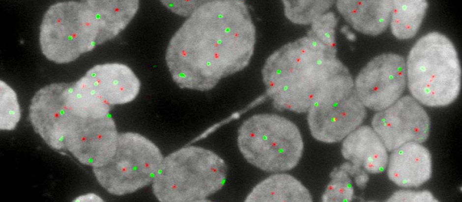 Núcleos de células neoplásicas de un cáncer de endometrio