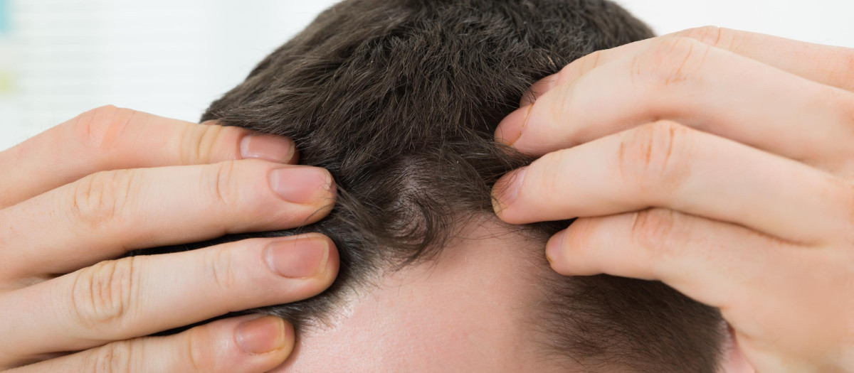 MAN CHECKING HAIRLINE AT HOME.LOSE,LOSING,LOOSING,LOSS,TEST,CHECKING,TESTING,SAMPLE,HAIR,HEAD,CARE,HUMANS,HUMAN BEINGS,PEOPLE,FOLK,PERSONS,HUMAN,HUMAN BEING,LOSE,LOSING,LOOSING,MEN,MAN,HAND,CLOSEUP,MALE,MASCULINE,SKIN,PERSON,LOSS,WELLBEING,LOOK,GLANCING,SEE,VIEW,LOOKING,PEEKING,LOOKING AT,SMALL,TINY,LITTLE,SHORT,ADULT,ONE,COMPANY,CONCERN,CORPORATION,MORNING,HIGH,TEST,CHECKING,TESTING,SAMPLE,PROBLEM,ADULTS,TOP,HAIRLINE,BALDNESS,TALL,HAIR,HEAD,TOMORROW,ANGLE,CARE,HOME,DANDRUFF,HAIRLOSS,DANDRUFF,HAIRLOSS,EXAMINING,SCRUTINY,TOUCHING,30S,INDOORS,ALOPECIA,RECEDING,MID,TRICHOLOGY