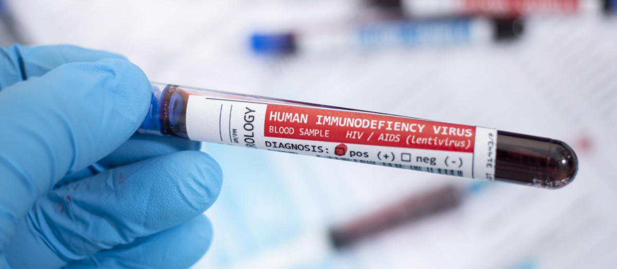 Muestra de sangre infectada con VIH
