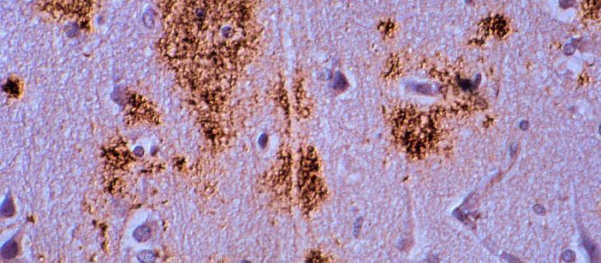 La covid grave daña al cerebro de forma similar al Alzheimer