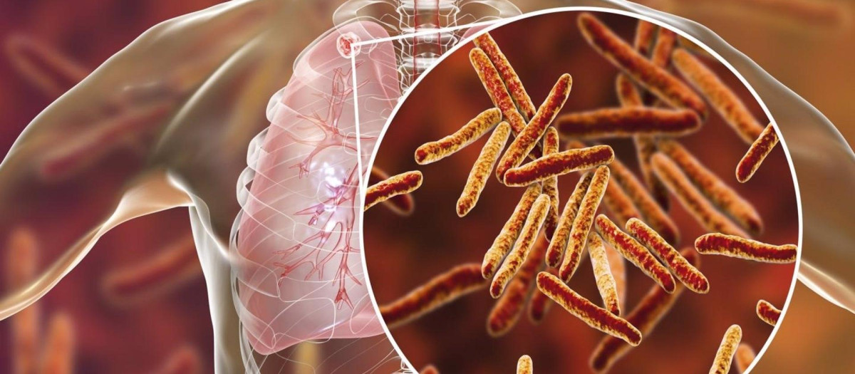 La tuberculosis es la segunda enfermedad infecciosa que más muertes causa tras la covid