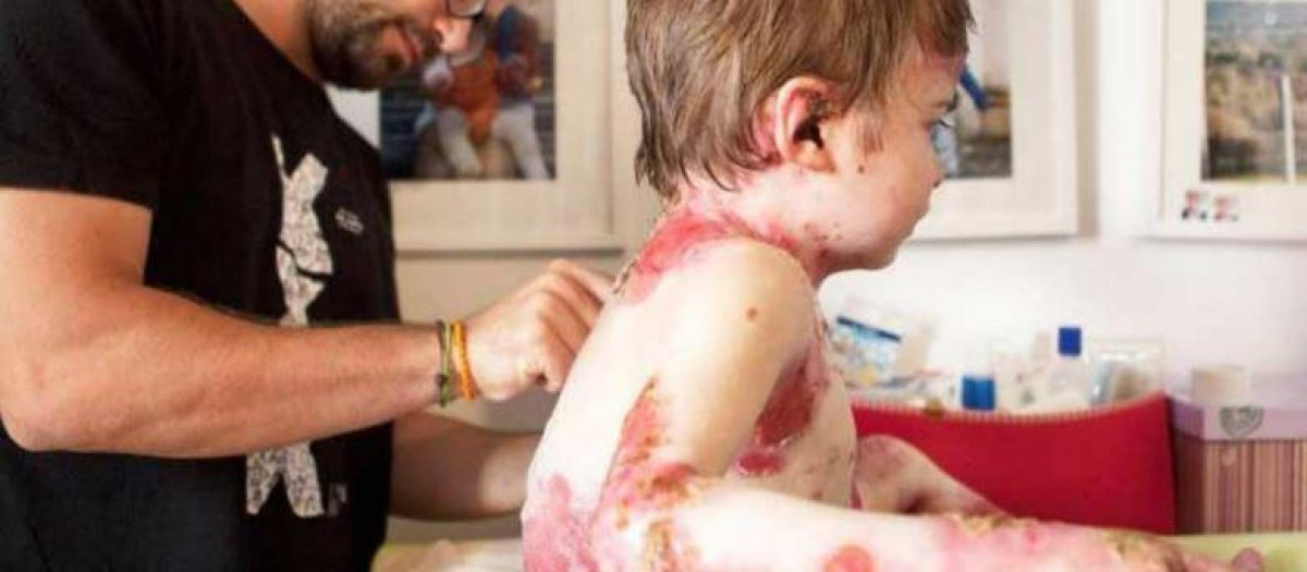 El medicamento, B-VEC, una terapia génica molecular tópica que mejoró el cierre duradero de las heridas en pacientes con epidermólisis bullosa distrófica recesiva