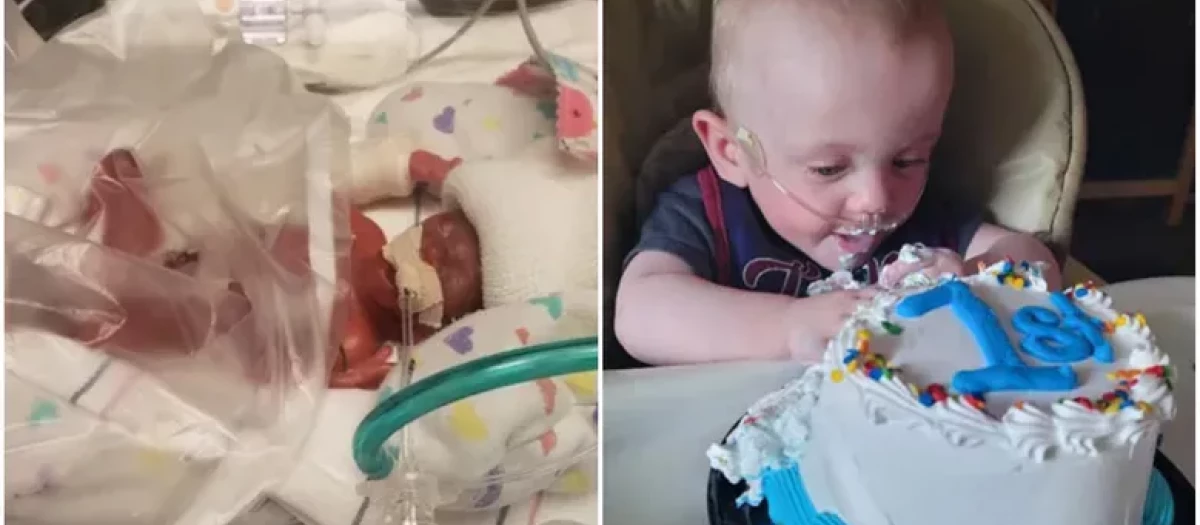 El bebé más prematuro del mundo nació en junio de 2020, con un peso de 340 gramos