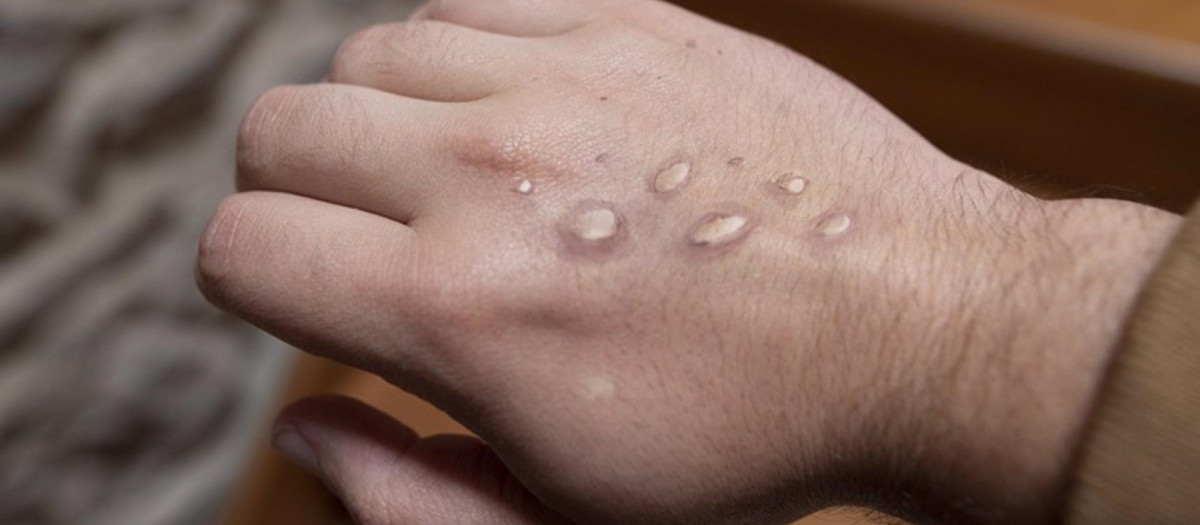 Erupción viruela del mono