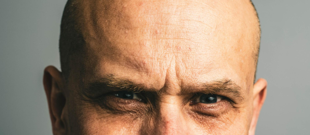 La calvicie es un problema frecuente entre los hombres