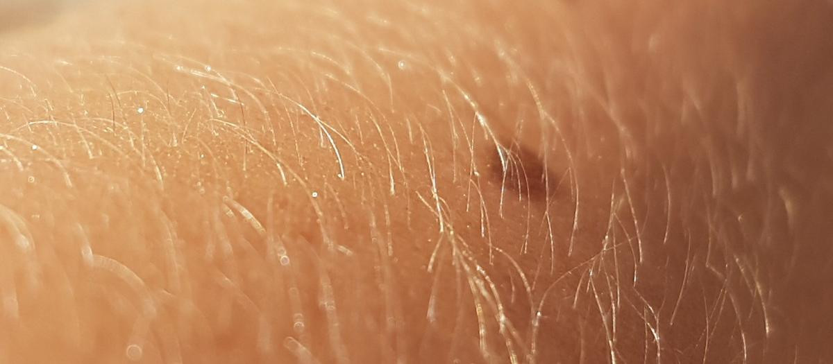Al incluir a pacientes con diferentes colores de piel, los investigadores han ampliado el espectro de resolución a diversas formas de melanoma