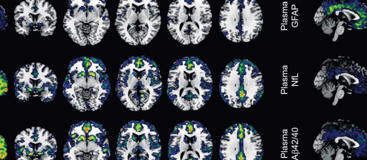 Un estudio identifica dos biomarcadores en sangre para captar los primeros indicios del Alzheimer