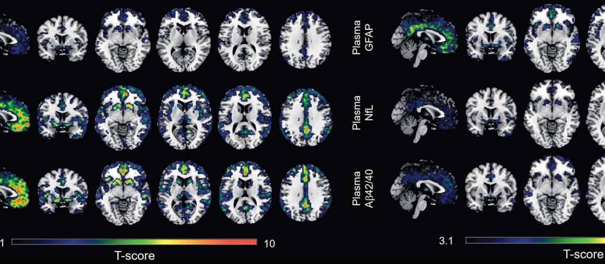 Un estudio identifica dos biomarcadores en sangre para captar los primeros indicios del Alzheimer