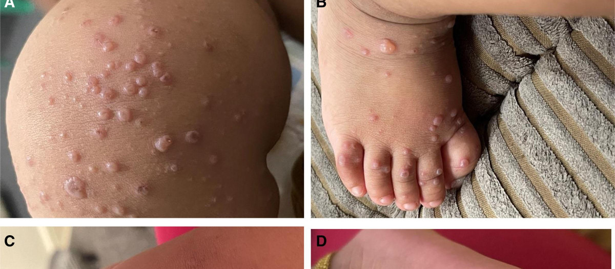 Detalles de ampollas causadas por la gripe del tomate