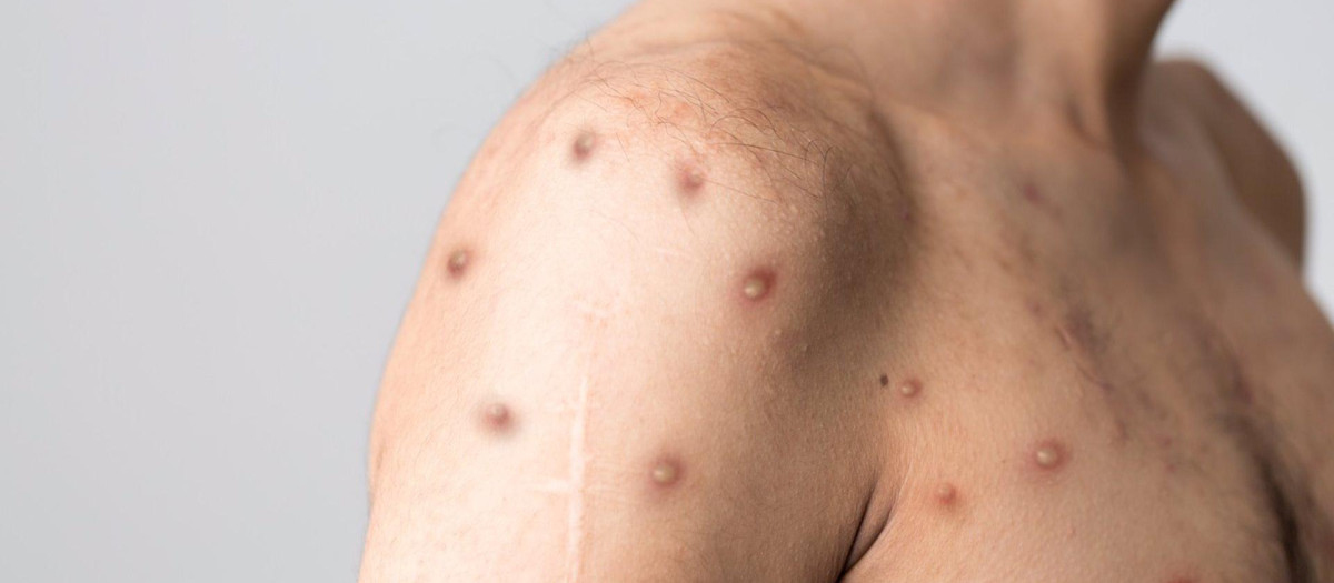 Hombre con pústulas de la viruela del mono
