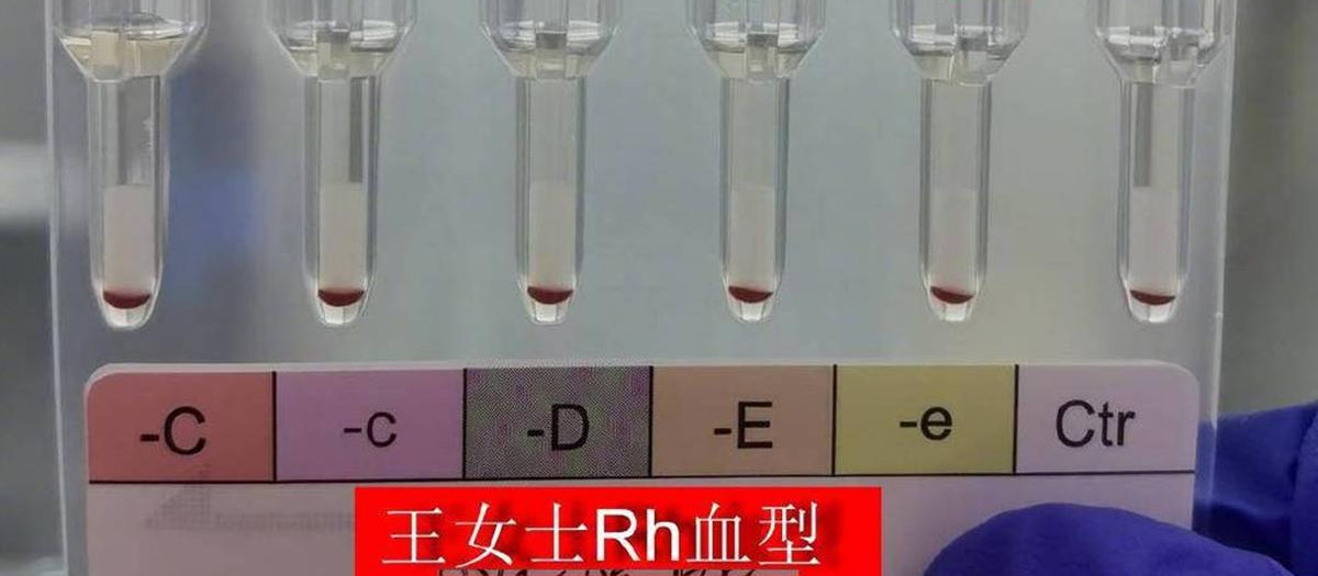 Muestras de la sangre dorada encontrada en la mujer.