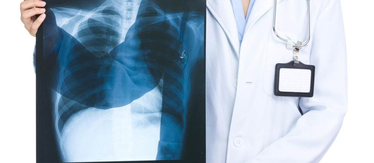 Cáncer de pulmón