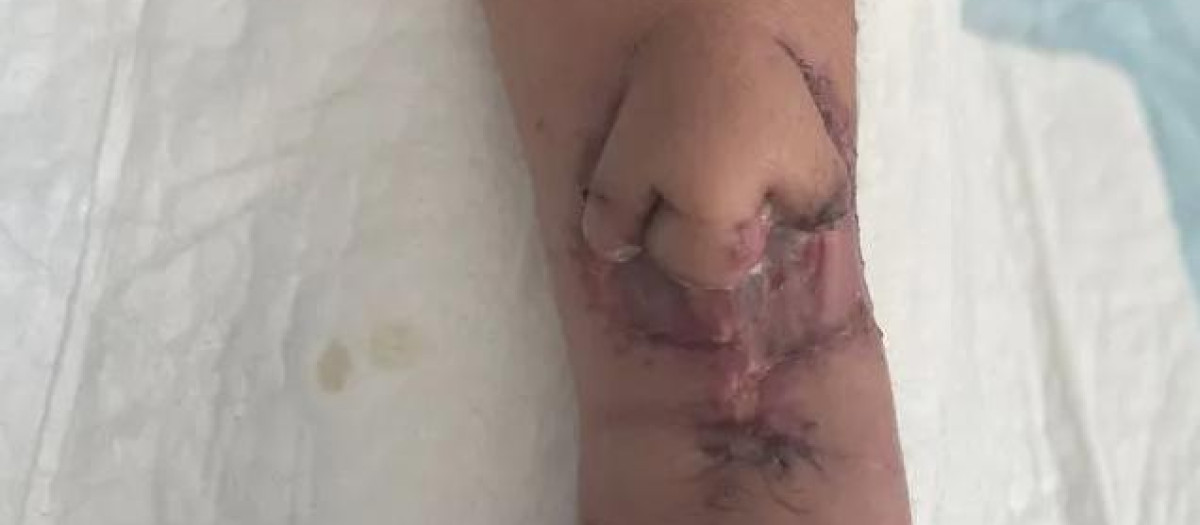 El implante sobre el brazo de la paciente