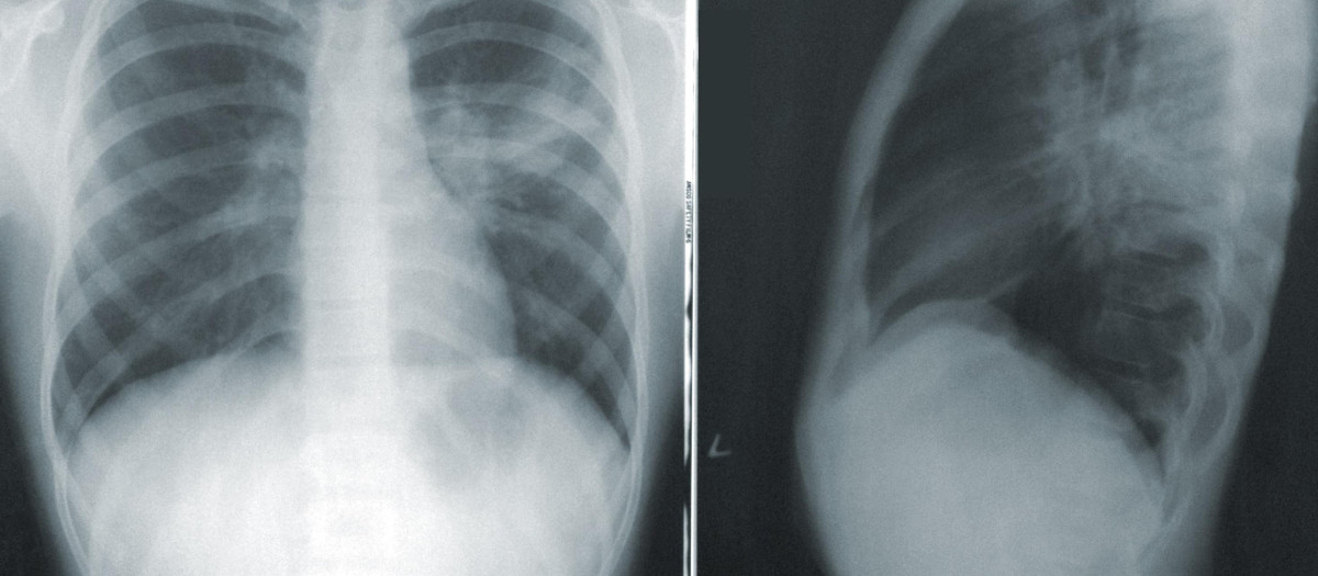 Radiografía de pulmón de una persona con coronavirus