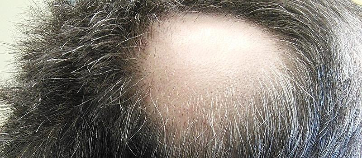 Alopecia areata