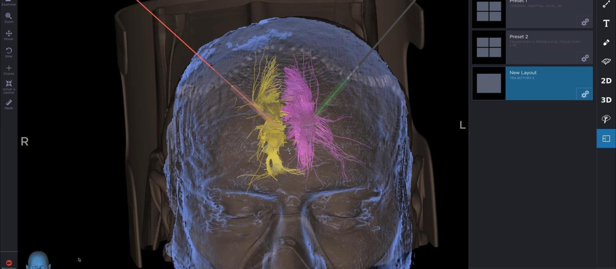 Imagen de la planificación de la cirugía en el Hospital del Mar de Barcelona