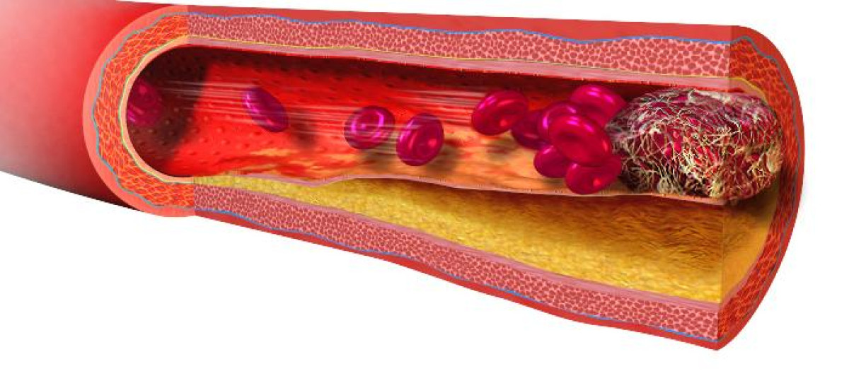 La trombosis es una afección que ocurre cuando se forma un coágulo de sangre en una vena profunda
