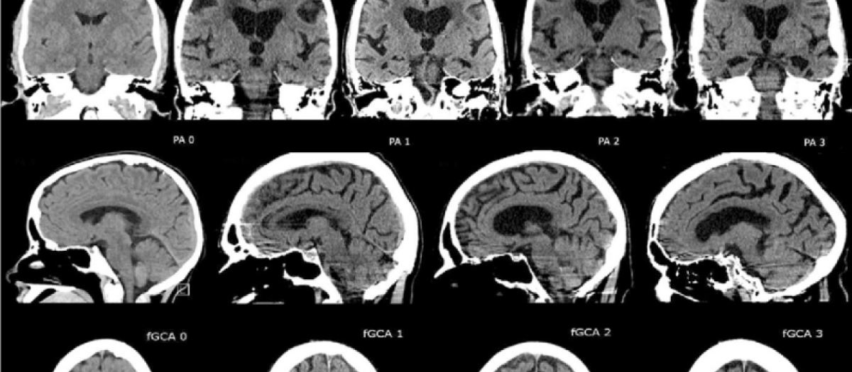 Tomografía cerebral