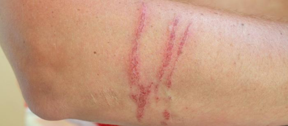 Herida en proceso de cicatrización