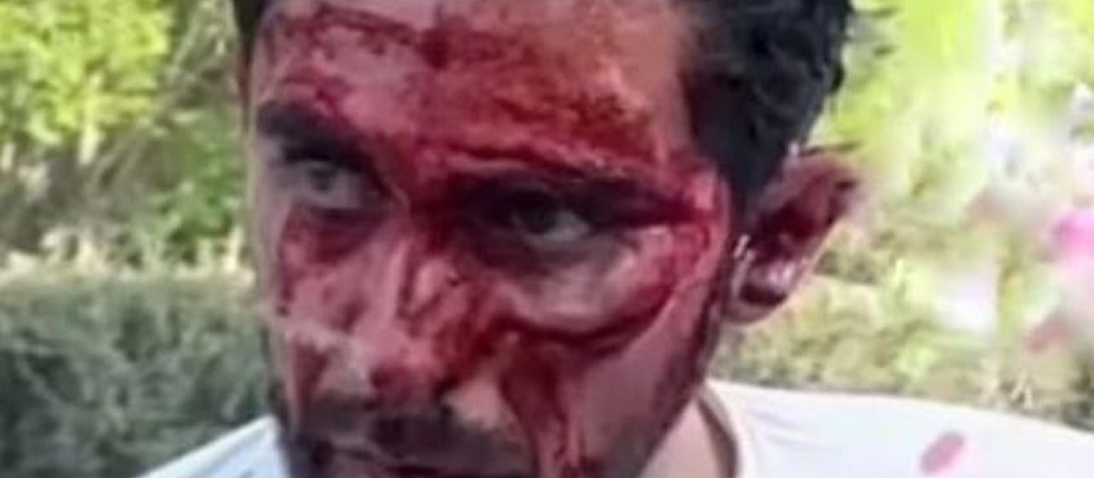 Alberto Contador, con la cara llena de sangre tras su caída
