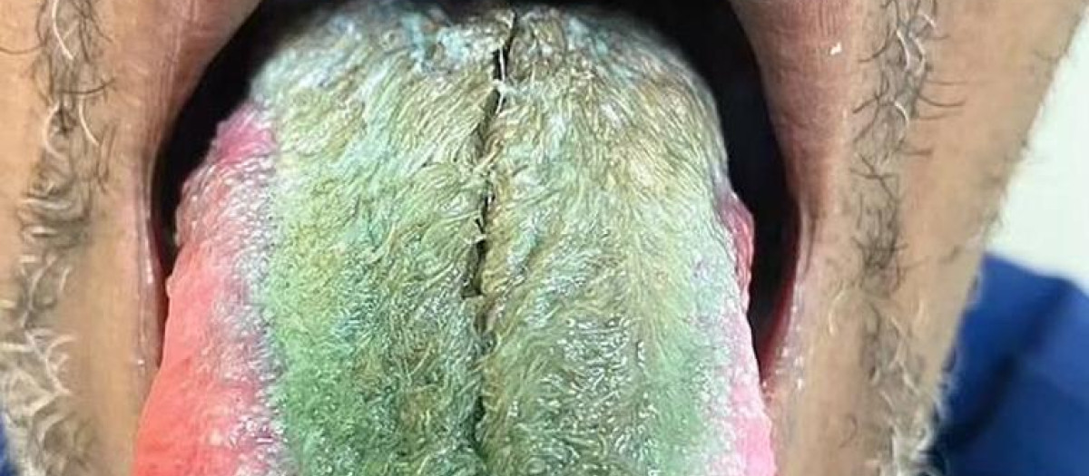 La lengua del paciente