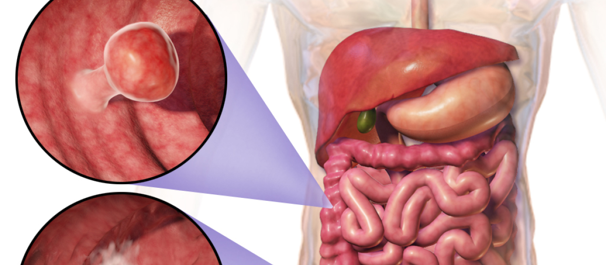 El cancer de colon se origina por pólipos que terminan derivando en tumor