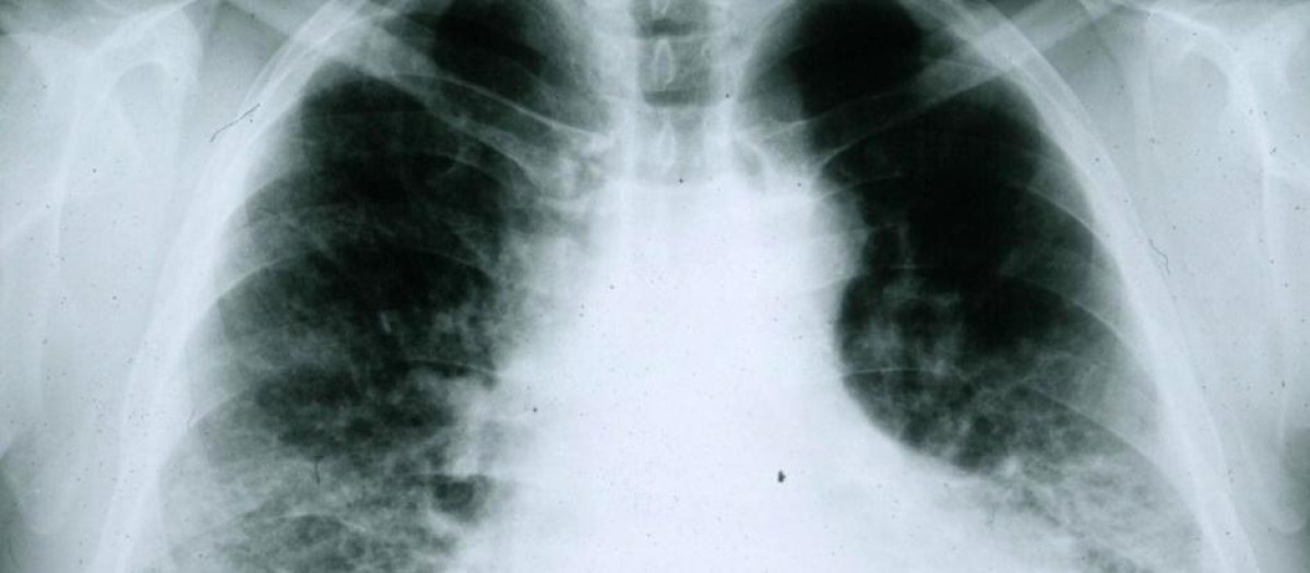 Cáncer pulmón