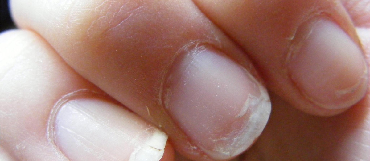 Manchas blancas en las uñas