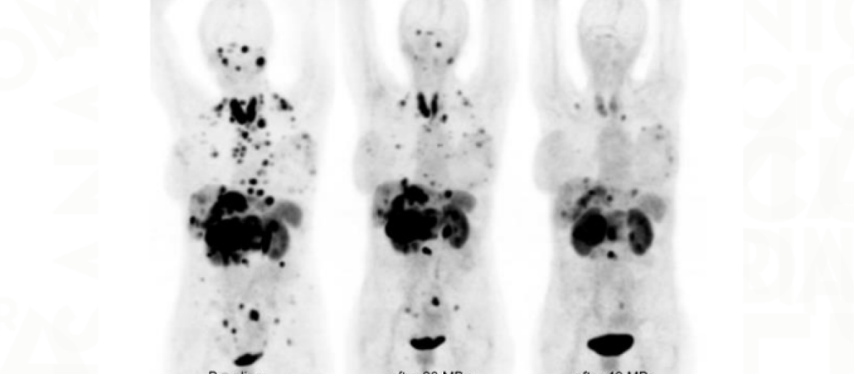 Paciente con cáncer al que se aplicó el tratamiento