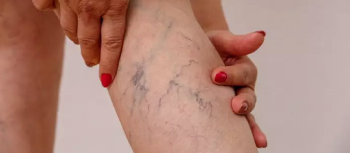 Imagen de una pierna con varices