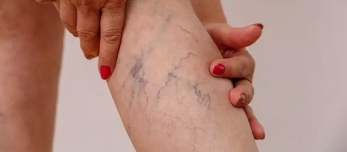Imagen de una pierna con varices