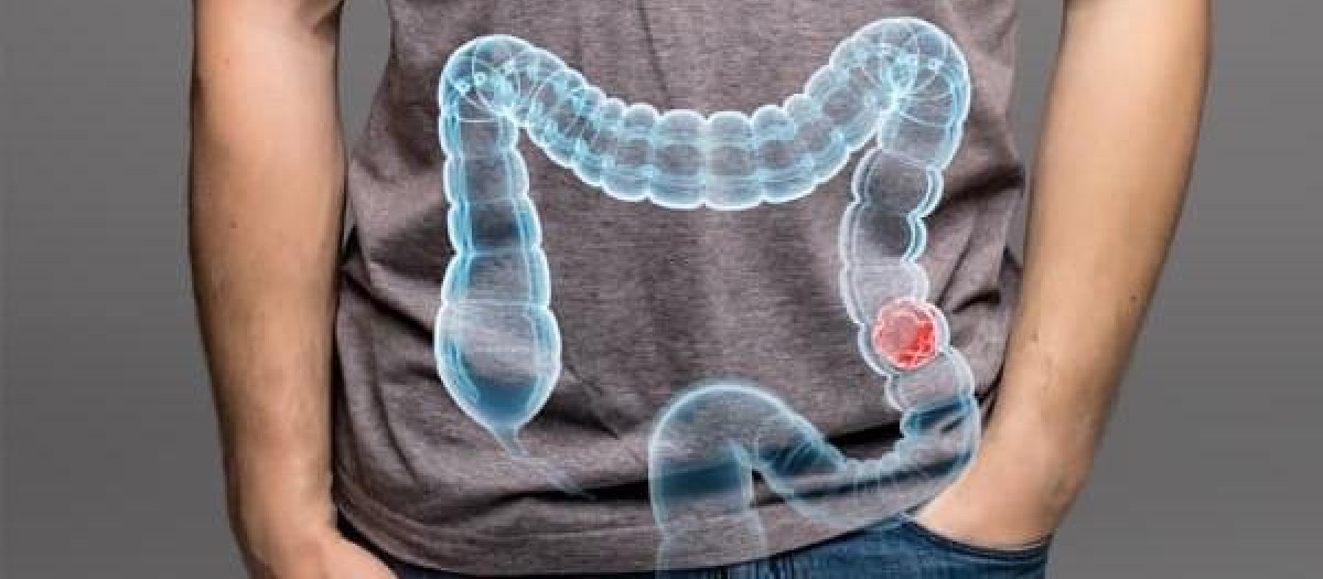 Imagen para promocionar el cribado de cáncer colorrectal