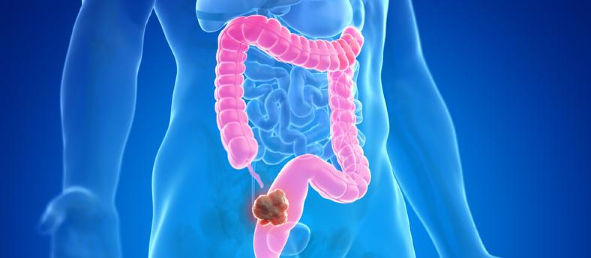 Recreación de un cáncer colorrectal