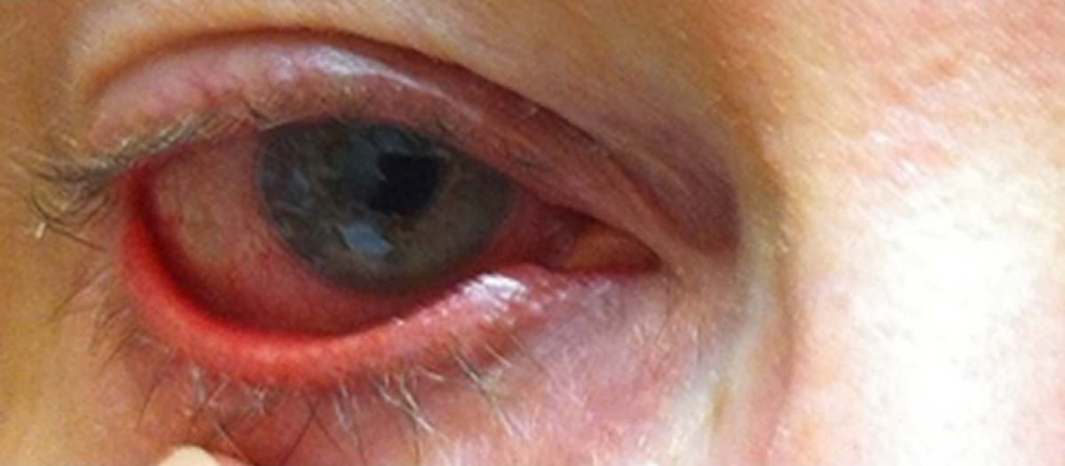 Rosacea ocular