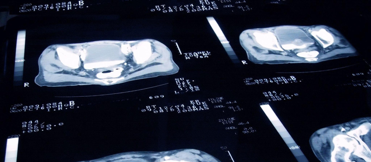 Radiografía que muestra cáncer de próstata