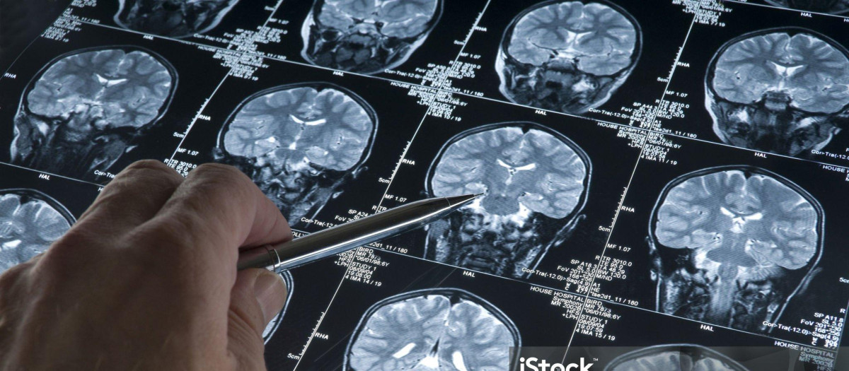 El CSIC consigue diseñar una molécula a través de IA, para tratar el alzhéimer y el cáncer