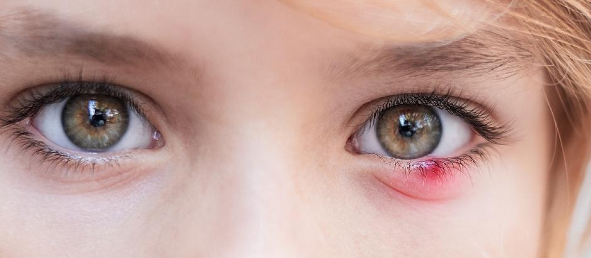 Un niño con un orzuelo, en una imagen de archivo