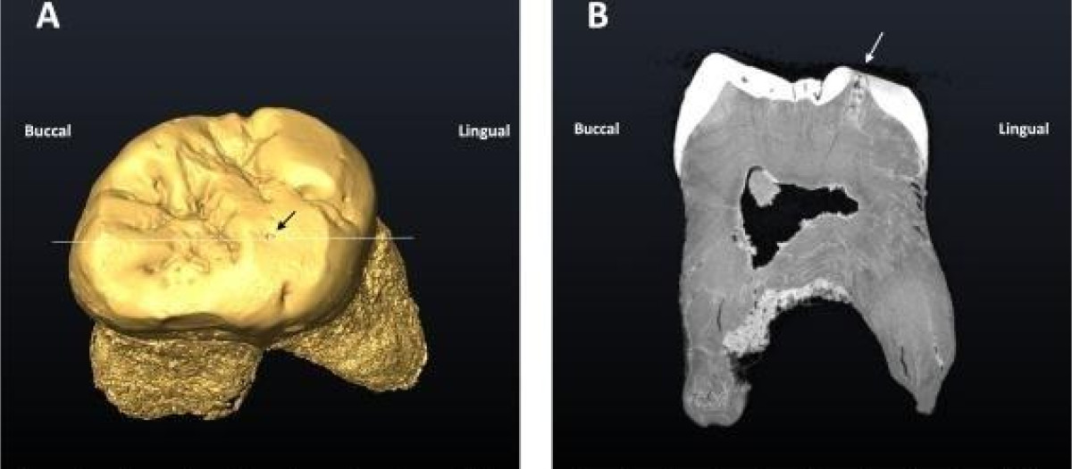El séptimo caso conocido de una caries dental en un neandertal