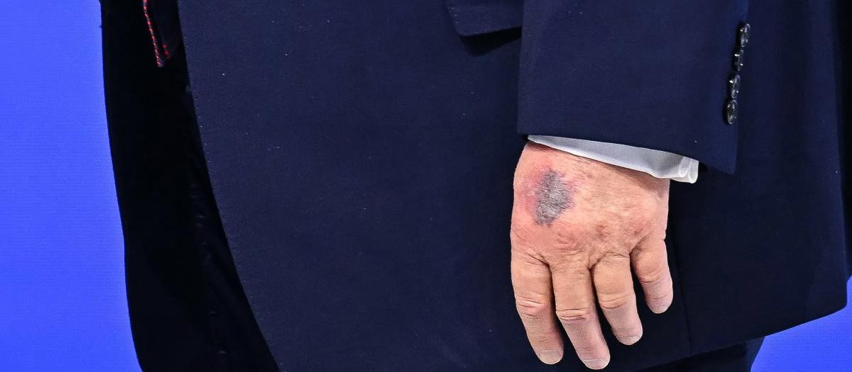 Donald Trump con un visible moratón en la mano