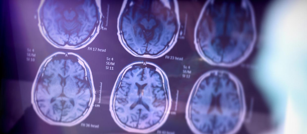 Análisis científico de la enfermedad de Alzheimer en el hospital